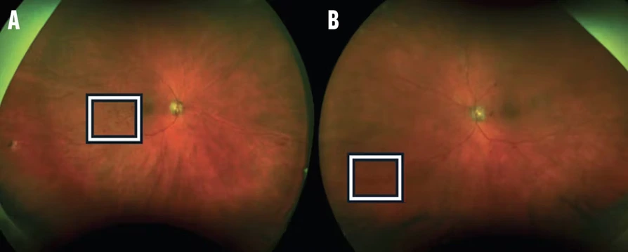 Retinal images showing highlighted areas for diagnostic comparison between two eye scans.