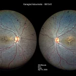 Revolutionizing Vision Care: AI-Powered Diagnosis of Rod-Cone Dystrophy