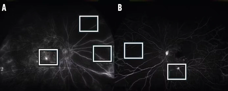 Side-by-side retinal angiography images labeled A and B showing highlighted regions of retinal blood vessels for comparison and analysis.