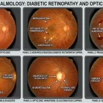 Early Detection of Retinal Diseases with AI Assisted Diagnosis: 7 Powerful Clinical Insights