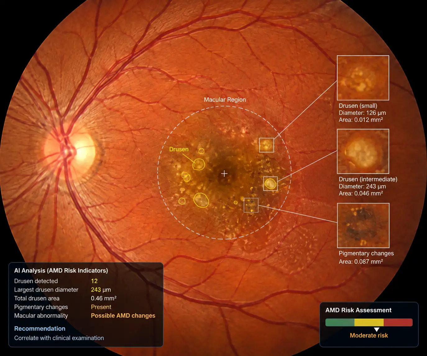 AI-Assisted Retinal AMD Analysis-AI-Powered Retina Image Analysis Market 1