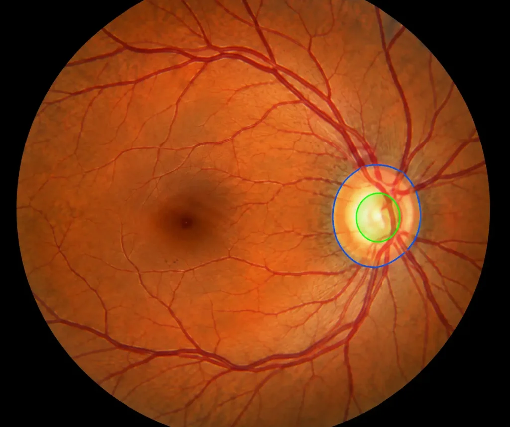 Annotated Retinal Optic Disc Analysis-Retinal Fundus Image Analysis for Diagnosis of Glaucoma 2