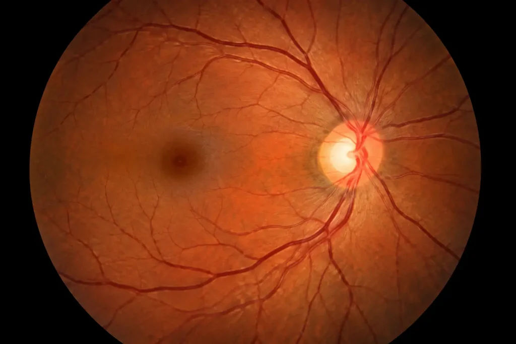 Detailed Retinal Fundus Image-Retinal fundus images for glaucoma analysis the riga dataset1