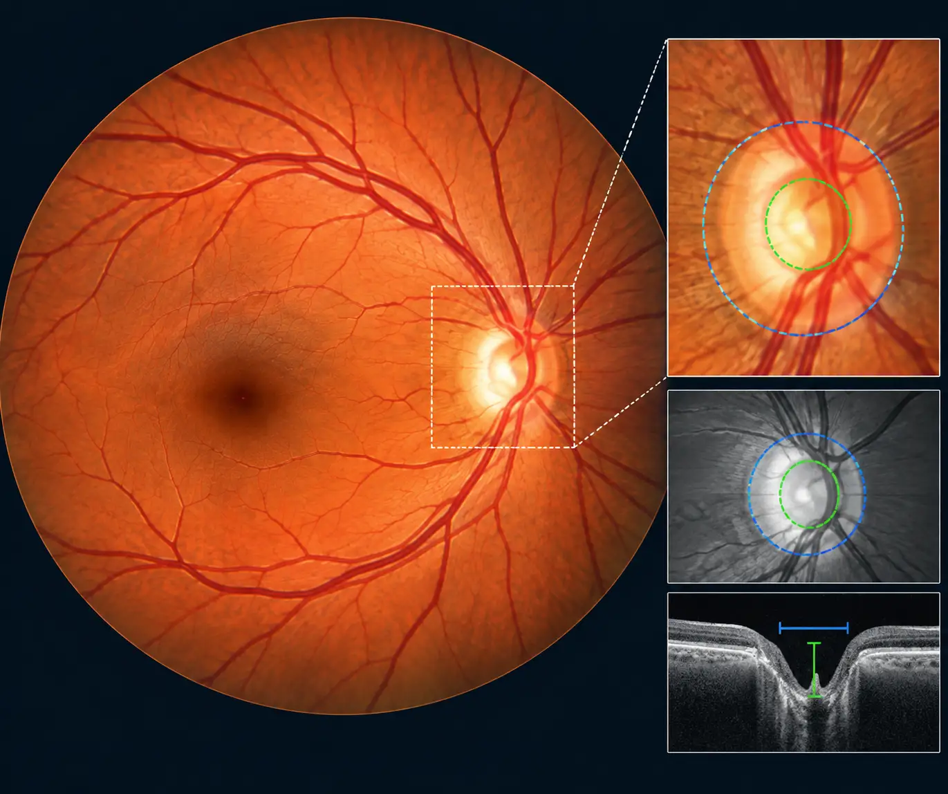 Glaucoma Retinal Imaging Analysis detail-Retinal Fundus Image Analysis for Diagnosis of Glaucoma 1