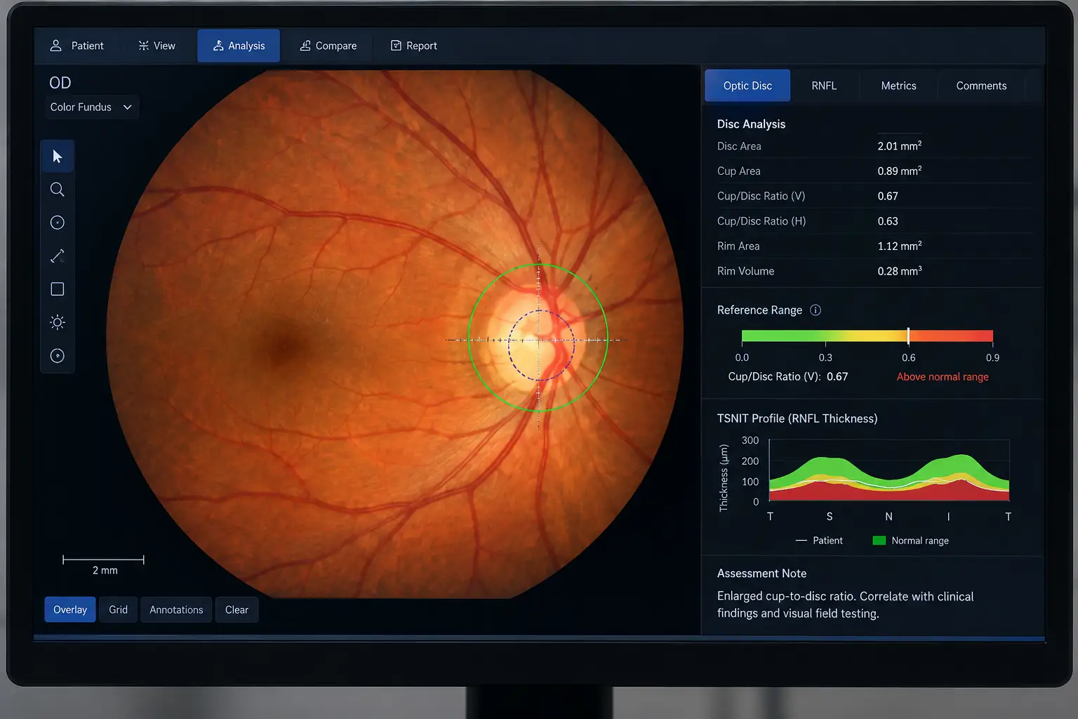Ophthalmology Retinal Analysis Monitor-Retinal Image Analysis for Detecting Glaucoma 1